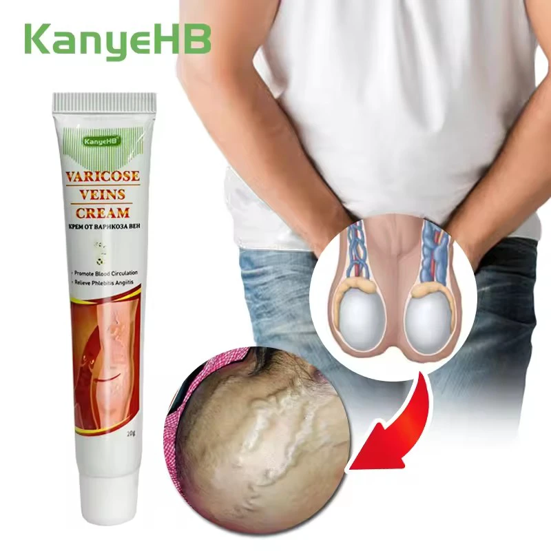 精索靜脈曲張軟膏生殖器精索靜脈曲張軟膏陰囊血管腫脹止痛軟膏靜脈曲張軟膏